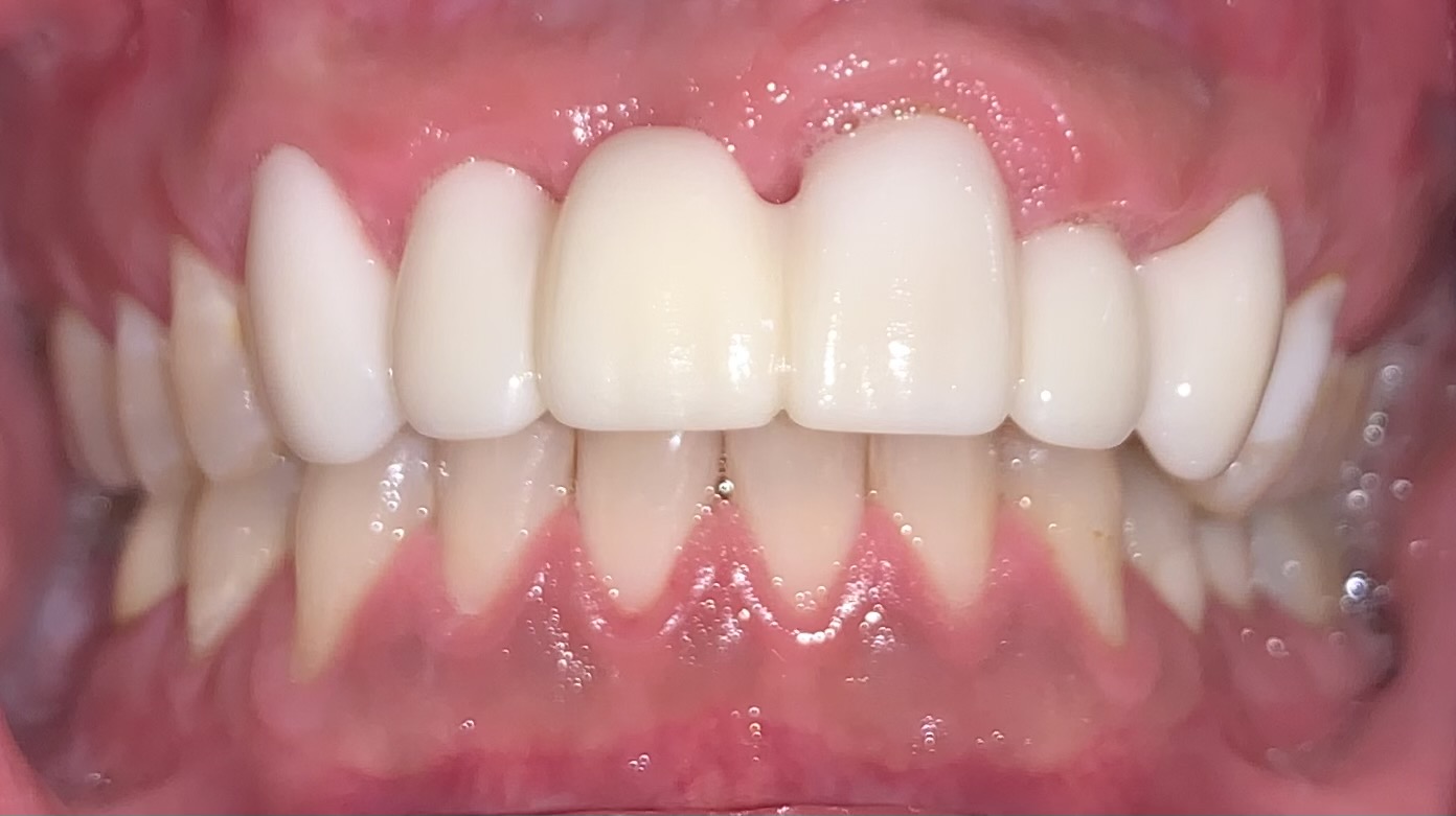 AFTER | Cosmetic crowns and bridges
