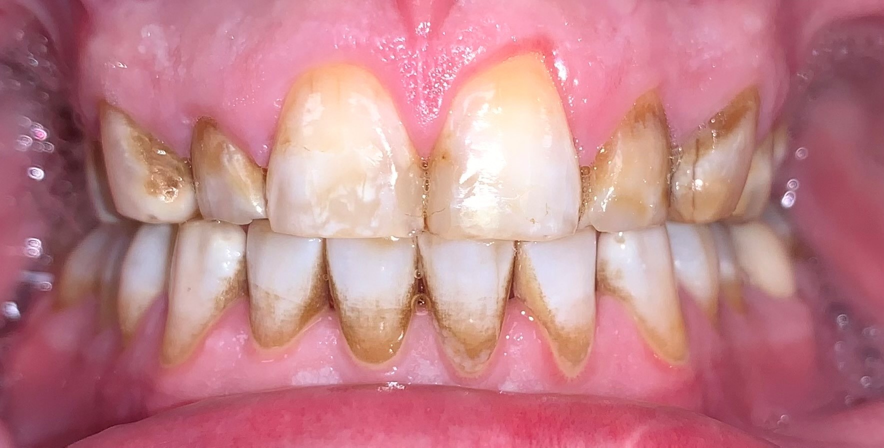 BEFORE | Cosmetic dentistry, wanted realistic looking teeth