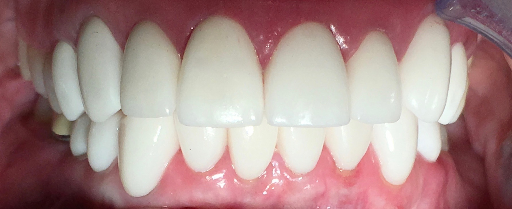 AFTER | Cosmetic veneers and crowns