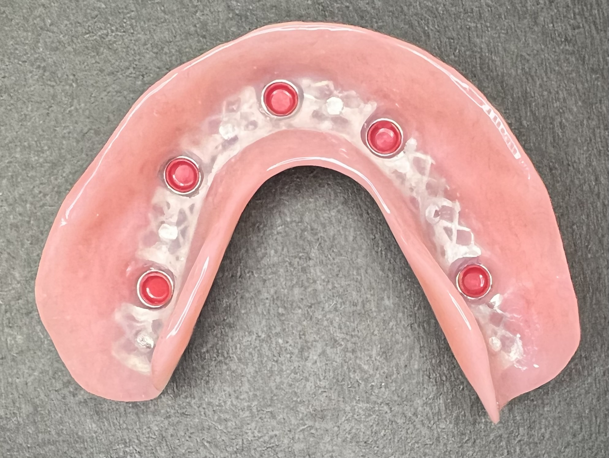 Lower implant retained denture
