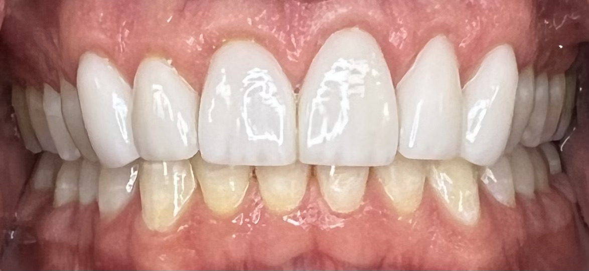 AFTER | Cosmetic dentistry
