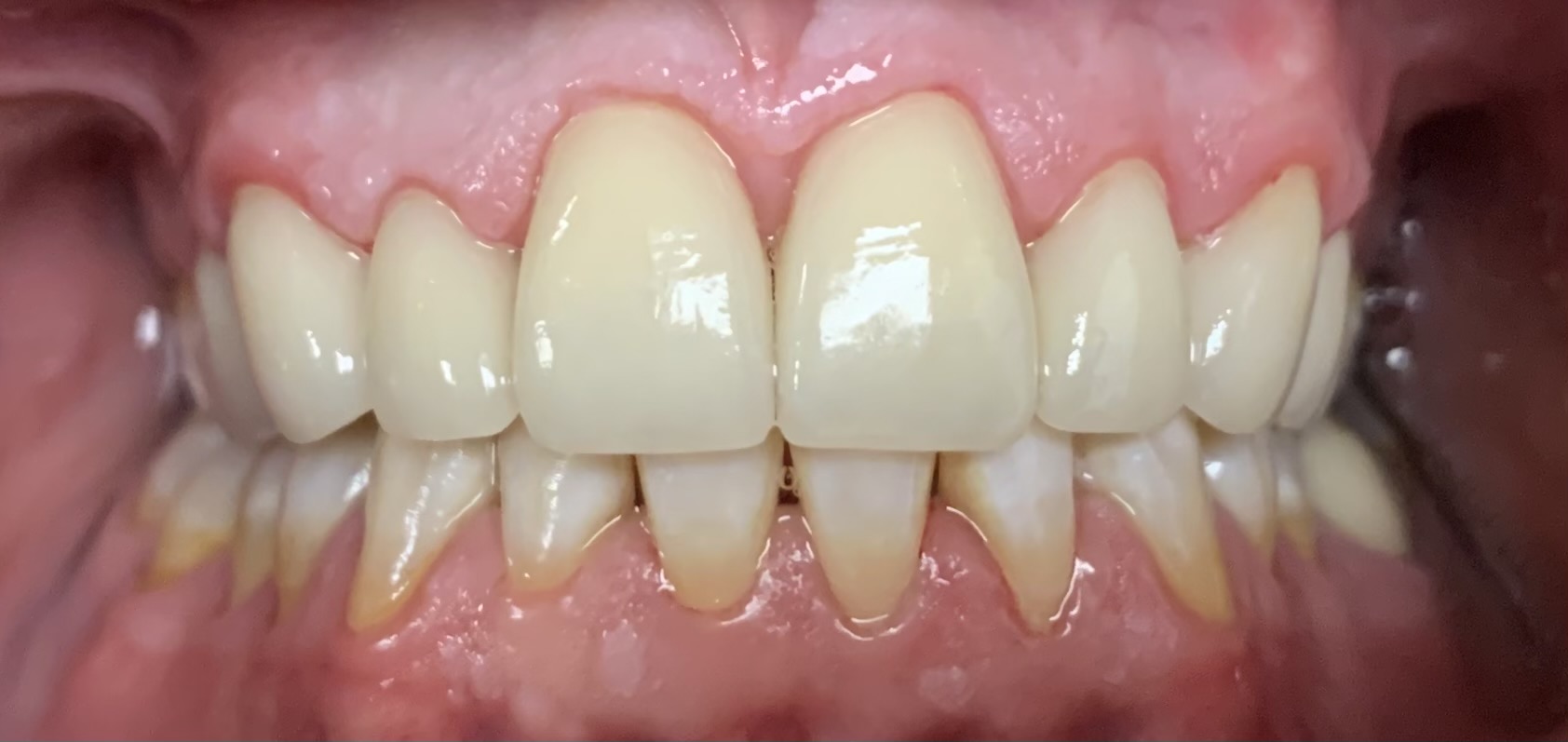AFTER | Cosmetic dentistry, wanted realistic looking teeth
