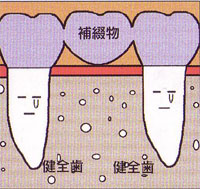 歯が中間で1本抜けた場合(ブリッジ)