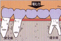 歯が中間で2本抜けた場合(ブリッジ)