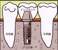 インプラントに支えられた歯の模式図