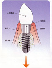 チタン製のインプラントとあごの骨が一体化して歯が復元できます。