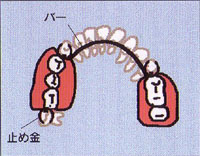 奥歯が数本抜けた場合(局部床義歯=部分入歯)