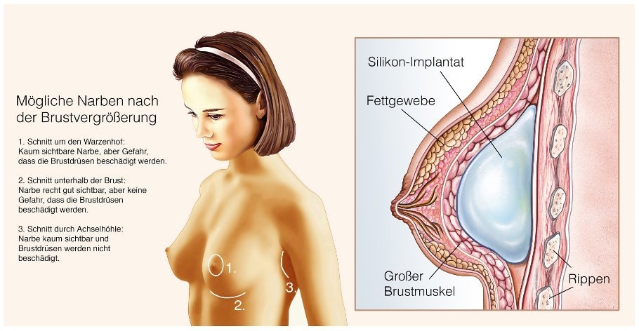 Nach op narben bilder brust Hässliche Brüste