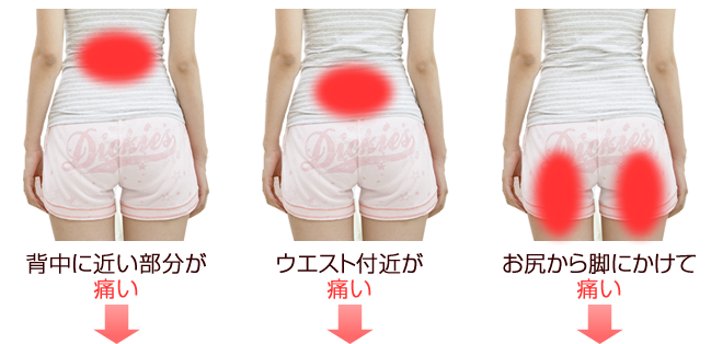 異なる腰痛のタイプ