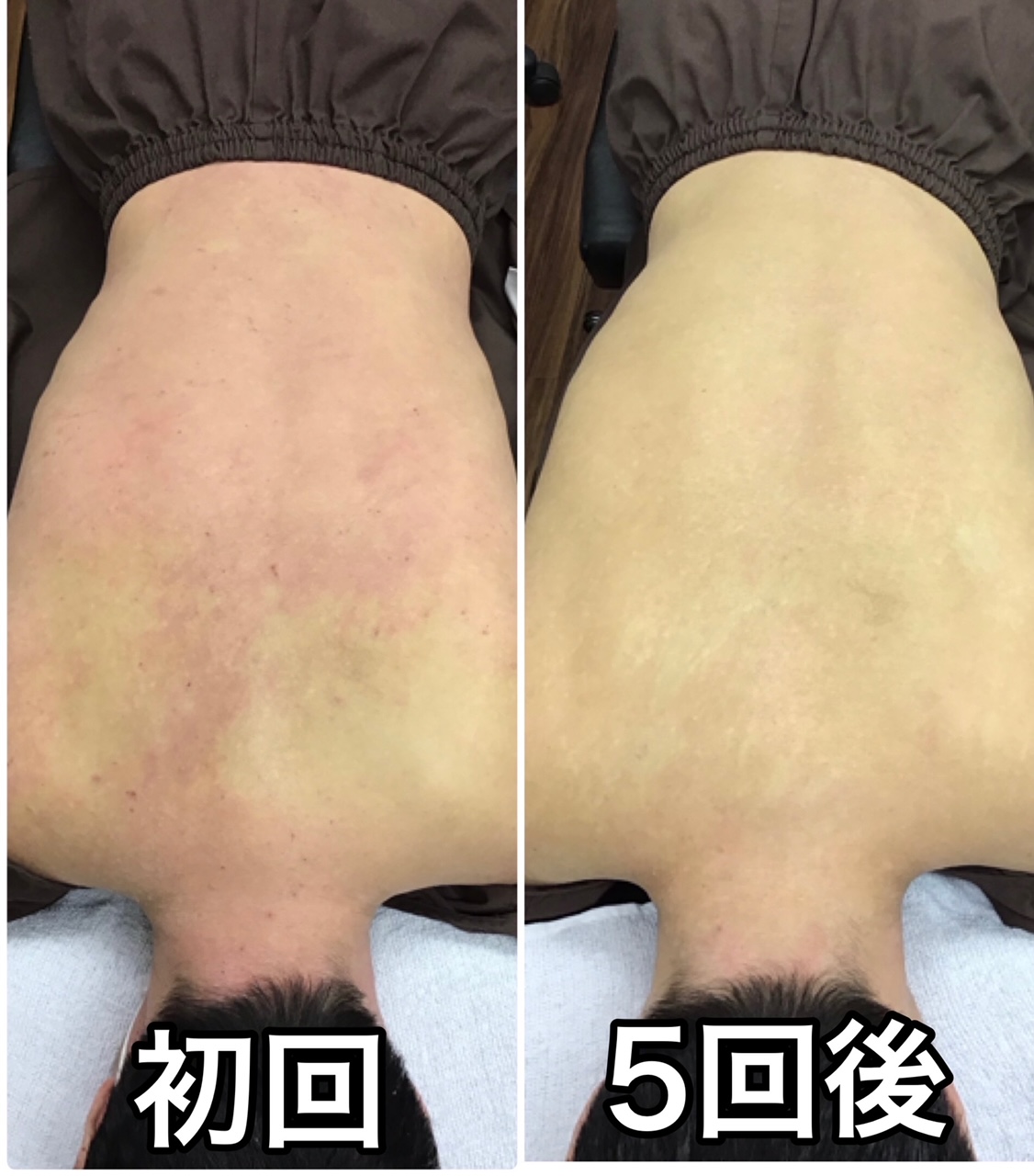 【中古】 アトピー性皮膚炎はこうして治す 病院では治らない！/無双舎/長谷川幸宏 中古】 アトピー性皮膚炎はこうして治す 病院では治らない