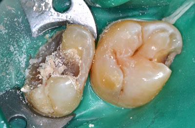 画像：　Amalgamによる虫歯の再治療の様子