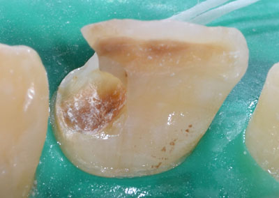 GI | グラスアイオノマーセメント | Glass Ionomer Cement GVBDO