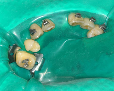 根尖病巣,前歯のレントゲン,歯の神経の治療,痛い歯,画像
