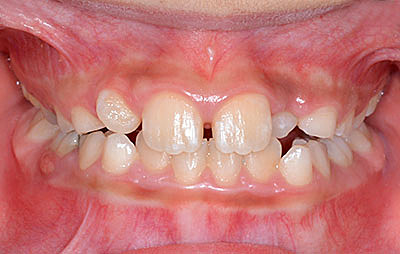画像：歯列矯正が必要かどうかは１５歳まで待つのが正解
