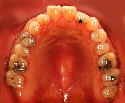 Universal Numbering System　永久歯の番号