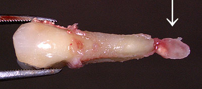 画像：小臼歯の根の先にできた根尖病巣