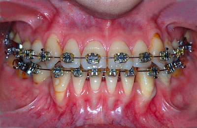 ジーナ浜松 01 裏側矯正失敗の顎関節症から復活 美しく生きるアメリカ歯科標準治療