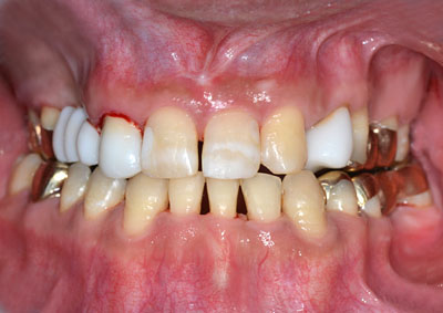 画像：　歯が死にたくなるほど悪かった人がかなり回復した様子