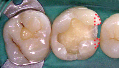 スライスカット・奥歯の虫歯治療方法 GVBDO