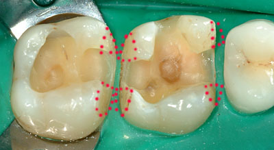 スライスカット・奥歯の虫歯治療方法 GVBDO