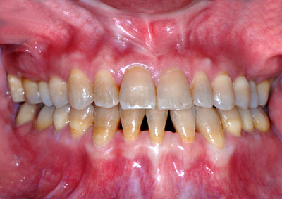 画像：tetracycline テトラサイクリン着色歯 ホワイトニング中 GVBDO