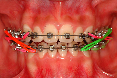 画像：　側湾症で悩む八重歯、開口の女子中高生の歯列矯正　