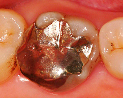 画像：　歯並びの悪い前歯がメタボンの３０代の主婦の銀歯の様子