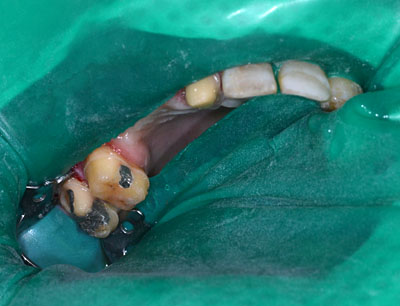 画像：　歯が死にたくなるほど悪かった人の様子