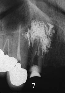 根尖病巣,前歯のレントゲン,歯の神経の治療,痛い歯,画像,完治