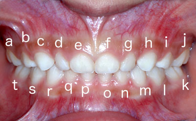 Universal Numbering System　乳歯の番号
