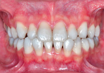 テトラサイクリン,着色歯,Tetracycline,ホワイトニング,歯を削る必要はない,実際, GVBDO