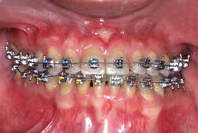 画像：　歯列矯正の失敗で顎関節症になったtetracycline着色歯の人の再矯正の様子
