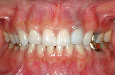 テトラサイクリン,着色歯,Tetracycline,ホワイトニング,歯を削る必要はない,実際, GVBDO
