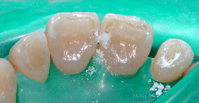 画像：　ラバーダムを装着し前歯の虫歯の再治療をレジンで行っている様子