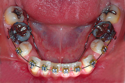 子供の歯,第一大臼歯,虫歯