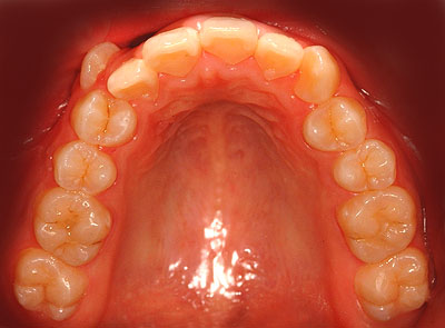 画像：　側湾症で悩む八重歯で開咬の女子中学生高校生の歯の様子
