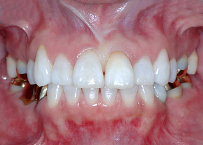 かよちゃん　神経治療失敗で茶色くなった歯ををホワイトニングで治す GVBDO
