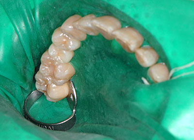 画像：　ラバーダムを装着し虫歯の再治療をAmalg amで行っている様子