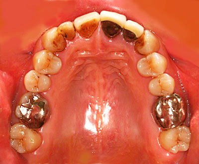 画像：　歯並びの悪い前歯がメタボンの３０代の主婦の銀歯だらけの歯の様子