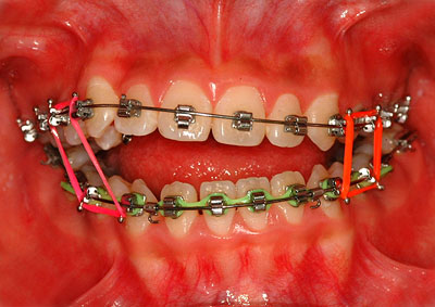 画像：　側湾症で悩む八重歯、開口の女子中高生の歯列矯正　