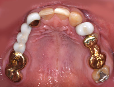 画像：　歯が死にたくなるほど悪かった人がかなり回復した様子