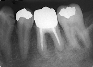根尖病巣,前歯のレントゲン,歯の神経の治療,痛い歯,画像