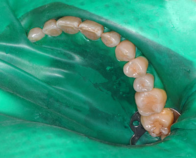 画像：　ラバーダムを装着し虫歯の再治療をAmalg amで行っている様子
