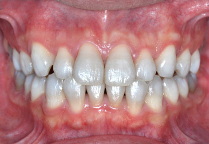 画像：tetracycline テトラサイクリン着色歯 ホワイトニング中 GVBDO