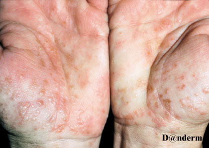 dysidrose sur les paumes de mains