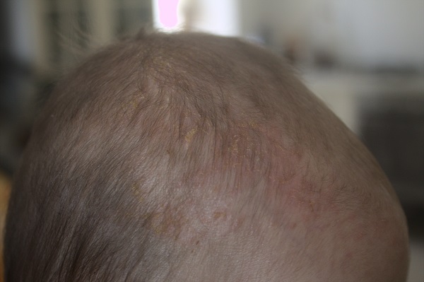 croutes de lait dans les cheveux d un bebe