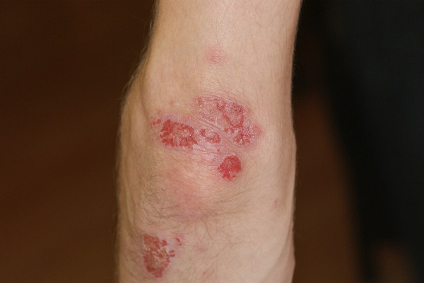 plaques d'eczéma rouges infectées