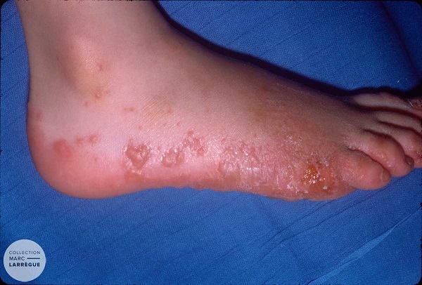 dyshidrose des pieds