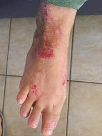 eczema lichenifie sur un cou de pied