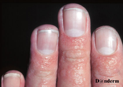 dysidrose sur la face dorsale de doigts